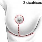 Les incisions au cours d'un lifting mammaire